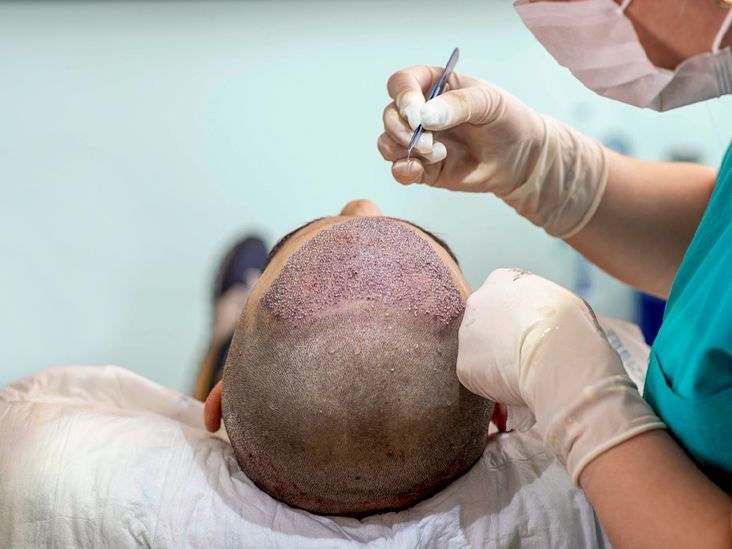 Kirurg utför en hårtransplantation på en man med tunt hår.